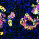 UK to invest £40 m in coming five years in Int’l Alliance for Cancer Early Detection