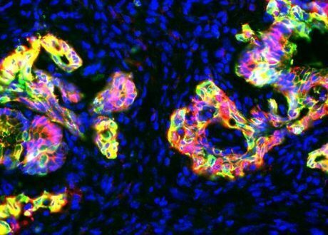 UK to invest £40 m in coming five years in Int’l Alliance for Cancer Early Detection